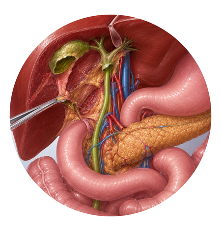 Extended Cholecystectomy